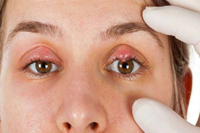 phương pháp chữa bệnh mắt lẹo