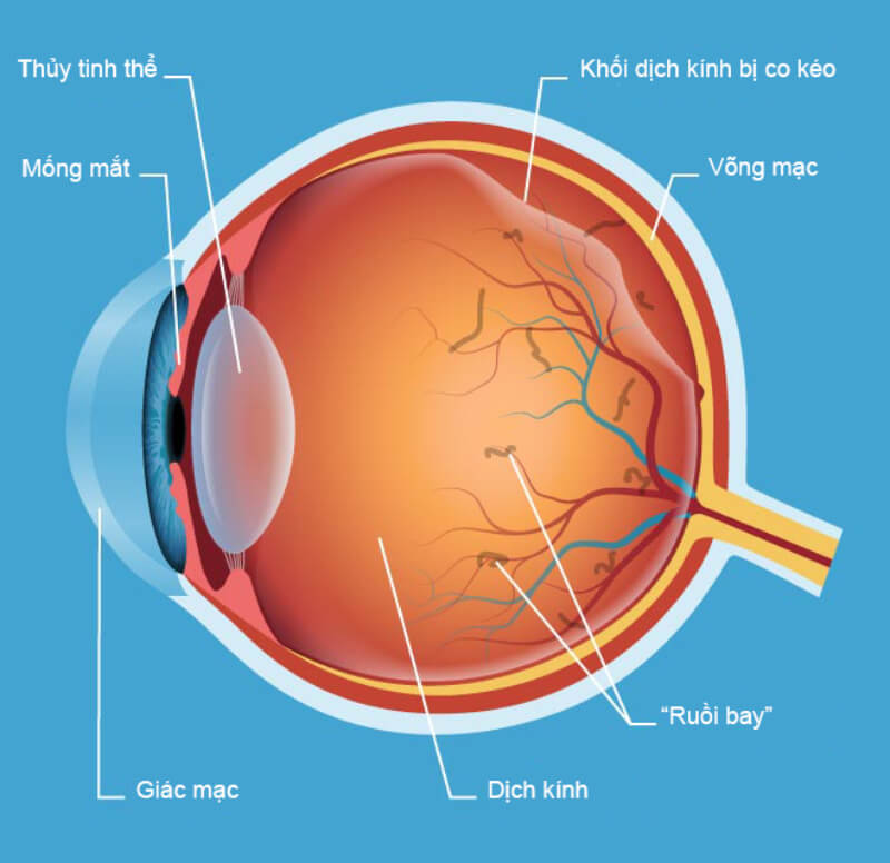 Bệnh mắt ruồi bay ở mắt là gì?