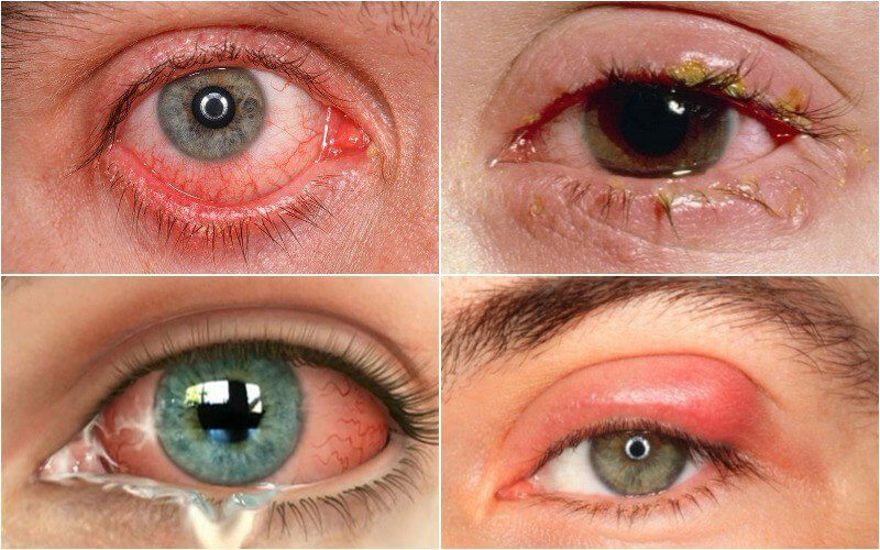triệu chứng và biếng chứng của bệnh ngứa mí mắt 