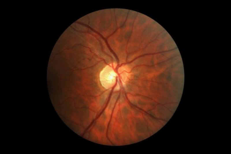 xem bệnh mắt mờ do viêm dây thần kính thị giác 