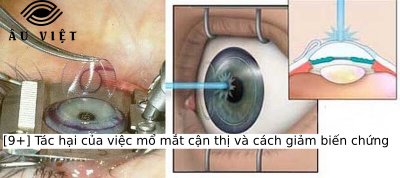 [9+] Tác hại của việc mổ mắt cận thị và cách giảm biến chứng